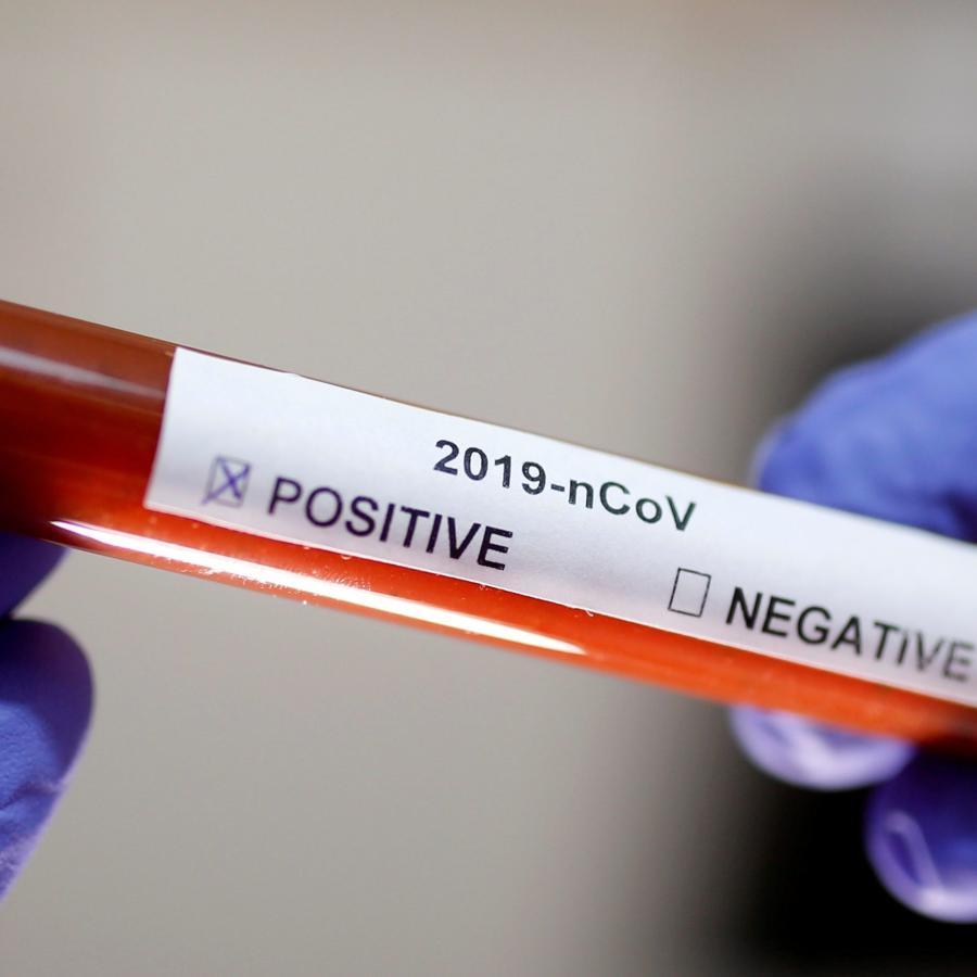 Teste coronavirus Teste de coronavírus da Rutgers pode testar 10 mil pessoas por dia