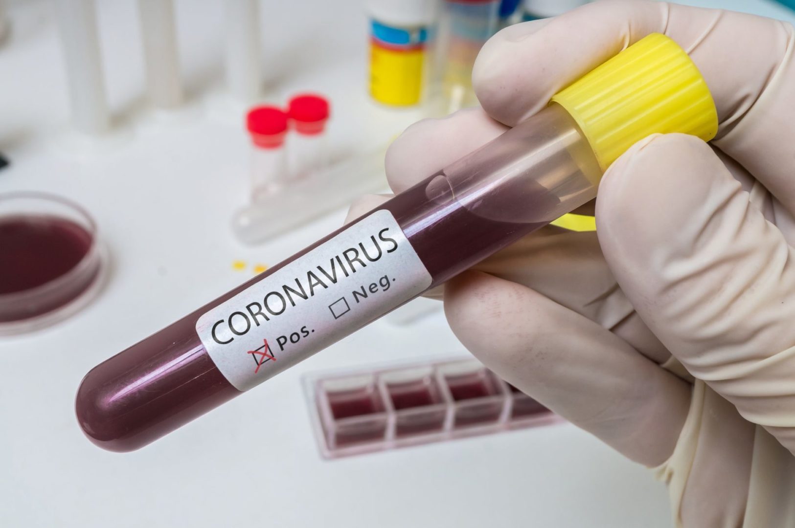 coronavirus blood test scaled Onde fazer o teste do Coronavírus em New Jersey